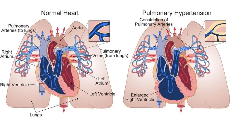 Pulmonary embolism treatment methods saving lives