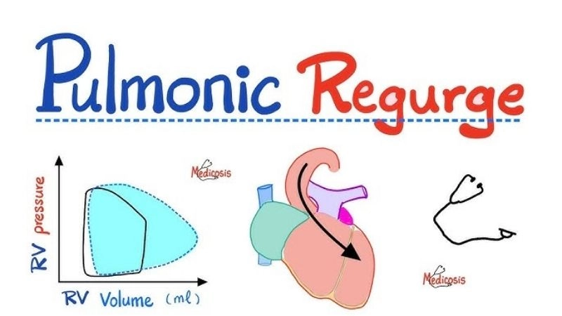 Pulmonary Regurgitation Symptoms often include fatigue and palpitations