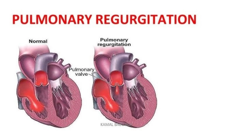 Pulmonary regurgitation treatment involves meds or surgery