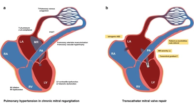 Pulmonary regurgitation causes include defects, valve damage