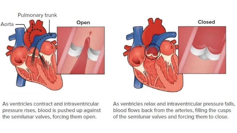 Pulmonary regurgitation in adults may worsen slowly