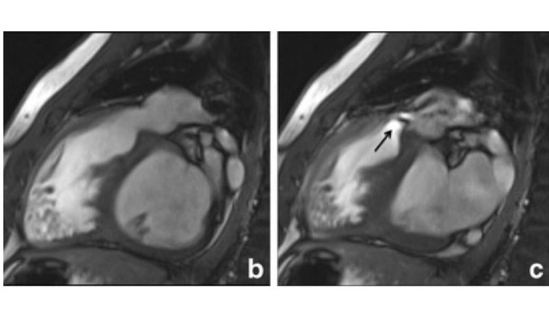 Moderate pulmonary regurgitation needs monitoring