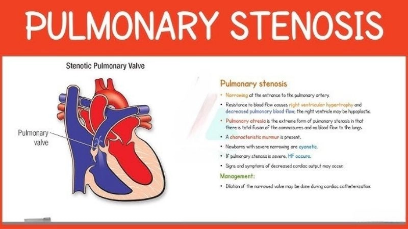 Pulmonary Stenosis Symptoms include fatigue and shortness of breath