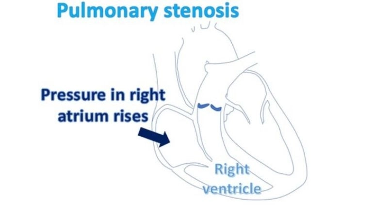 Pulmonary Stenosis In Babies often linked to congenital defects