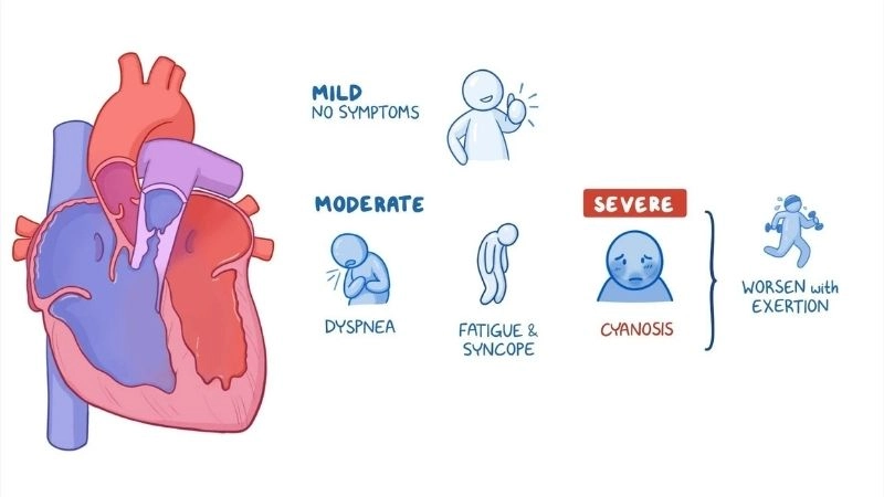 Moderate Pulmonary Stenosis may require intervention