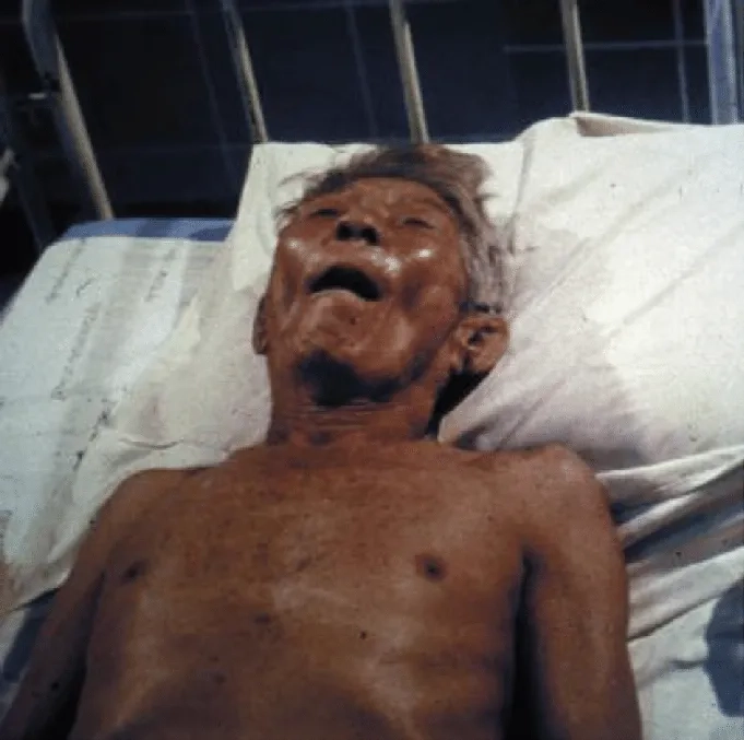 The Question of Is Rabies Curable Explained