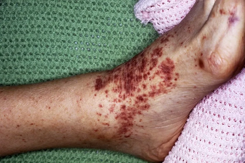 Chart illustrating common rat-bite fever symptoms