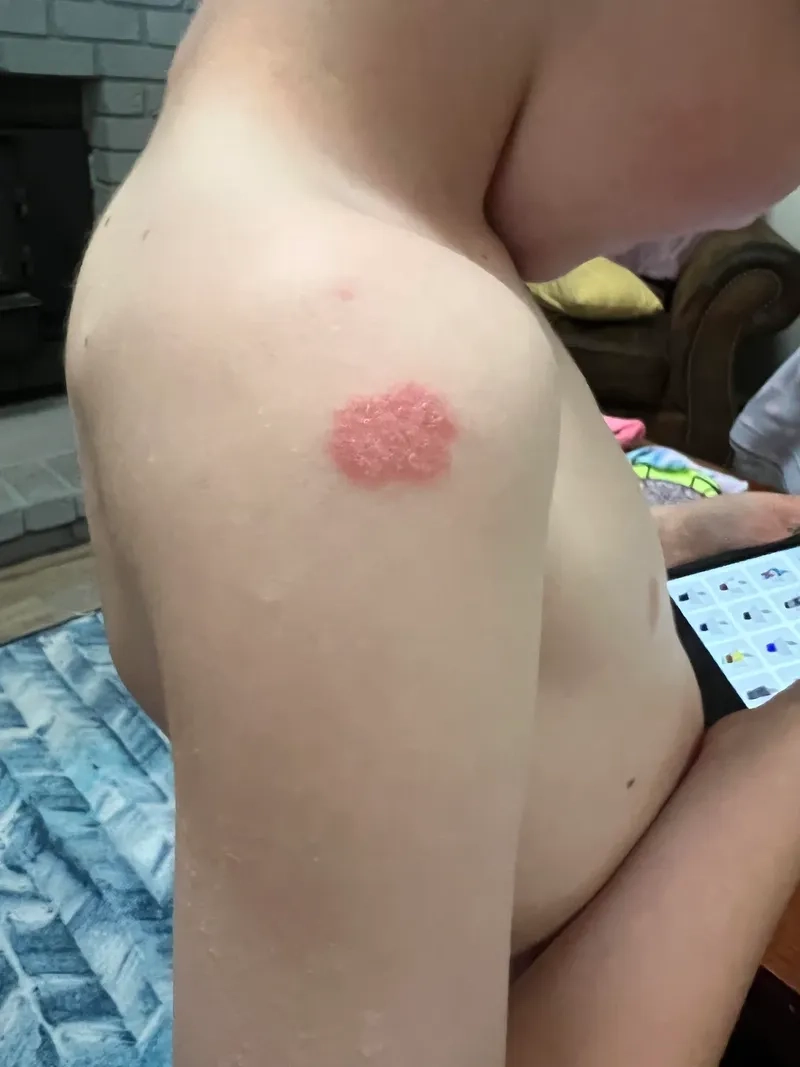 Infographic explaining what is rat-bite fever