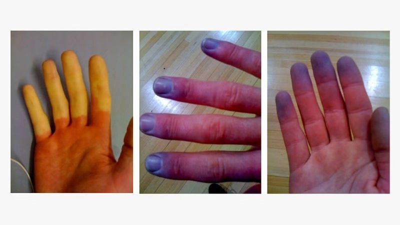 Raynaud's syndrome and circulation challenges