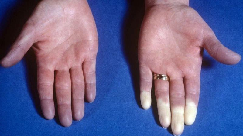 What is Raynaud's phenomenon simple explanation