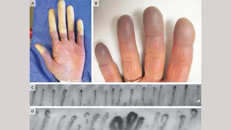 Raynaud's disease vs phenomenon clear differences