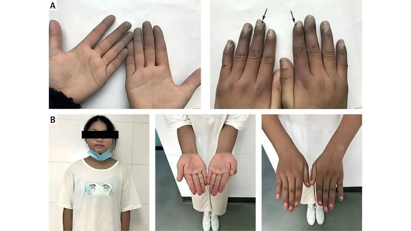 Raynaud's and cold weather triggering flare ups