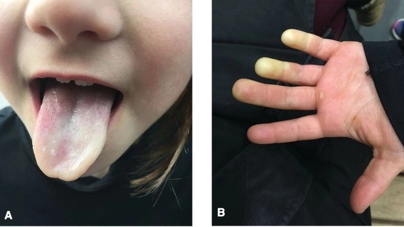 Is Raynaud's a serious condition to worry about