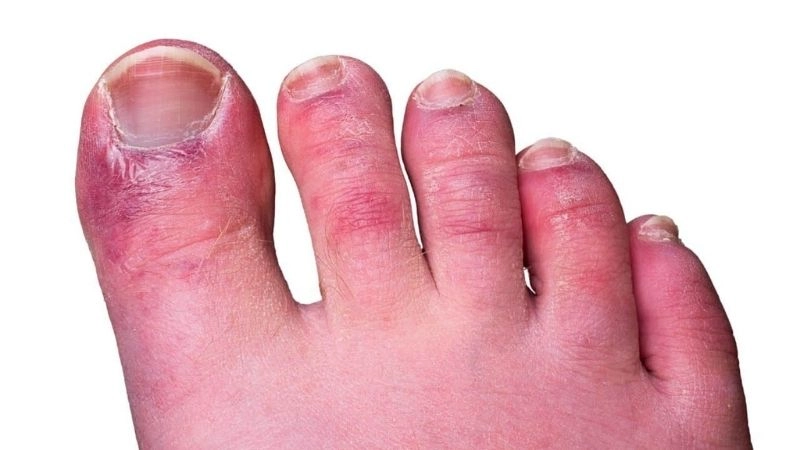 Raynaud's phenomenon in feet causing discomfort