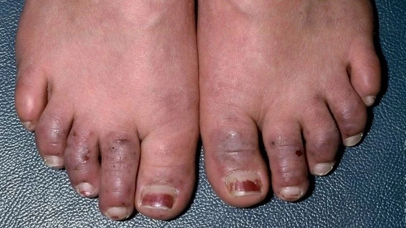 Raynaud's phenomenon natural treatment approaches