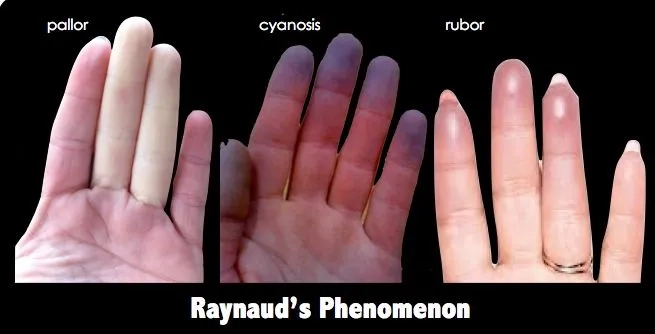 A classic example of fingers turning white and cold