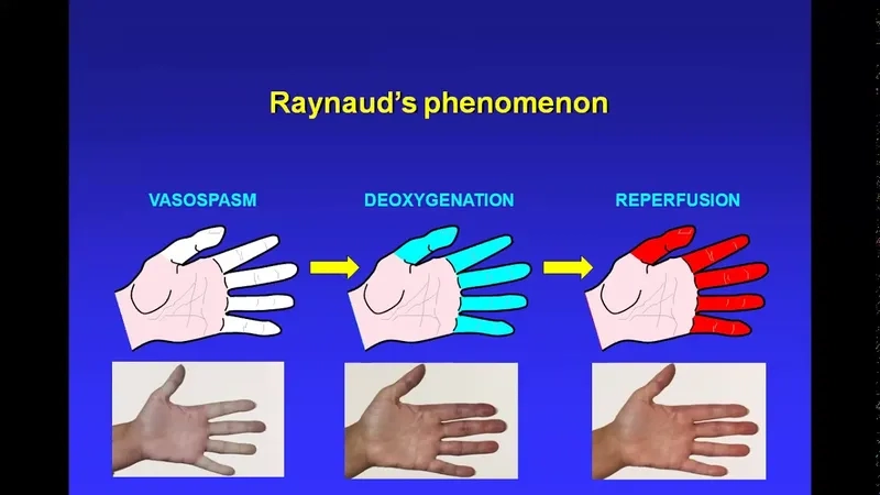 A visual guide to Raynaud's phenomenon symptoms