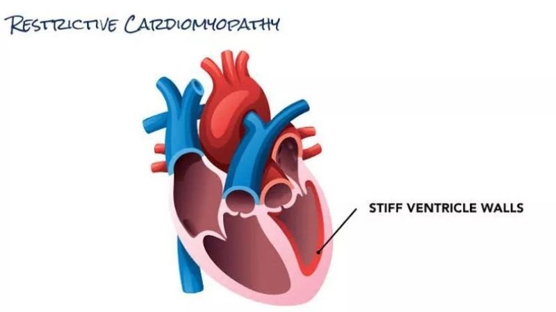 Restrictive cardiomyopathy symptoms early signs of stiff heart