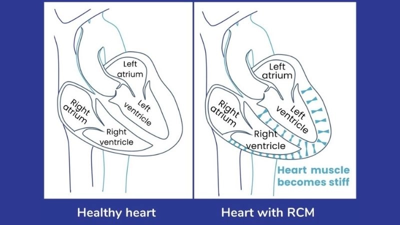 Restrictive cardiomyopathy treatment managing heart function