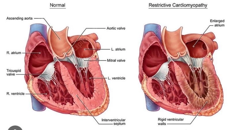 Restrictive cardiomyopathy causes underlying medical conditions