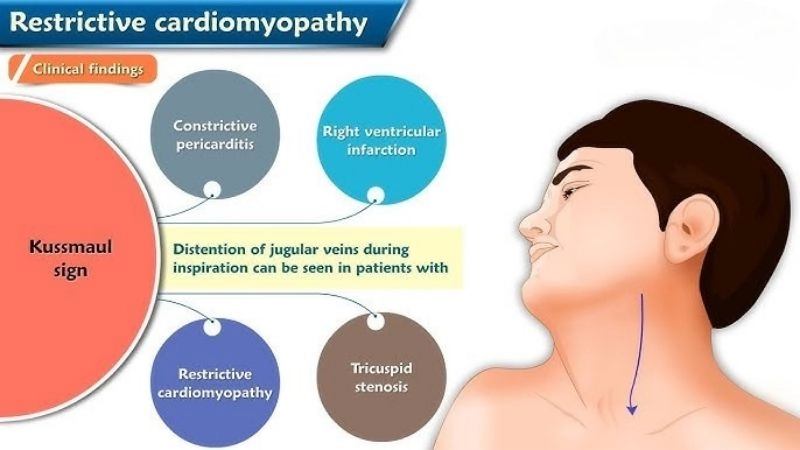 Restrictive cardiomyopathy life expectancy outlook for patients