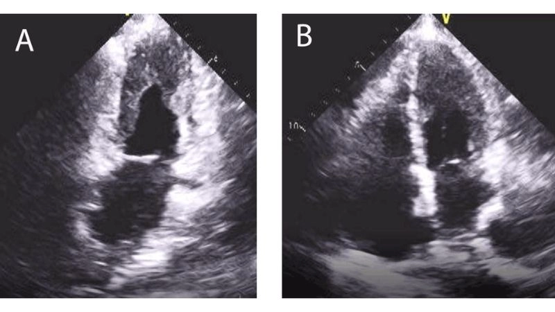 Restrictive cardiomyopathy diagnosis early detection is essential