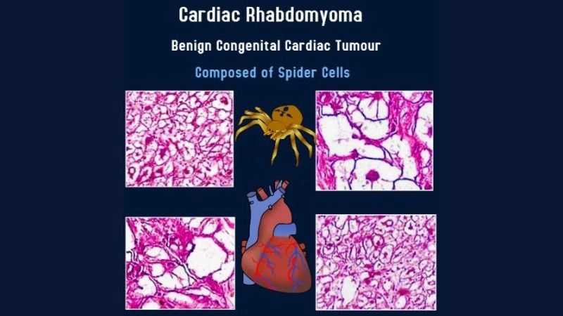 Strong link rhabdomyoma and tuberous sclerosis