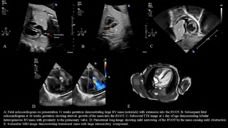 Insightful capture of fetal rhabdomyoma findings