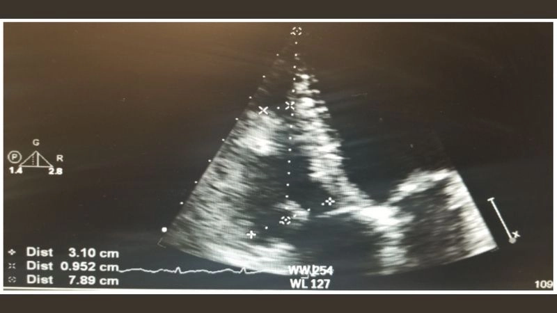 Real cases of rhabdomyoma in children hearts