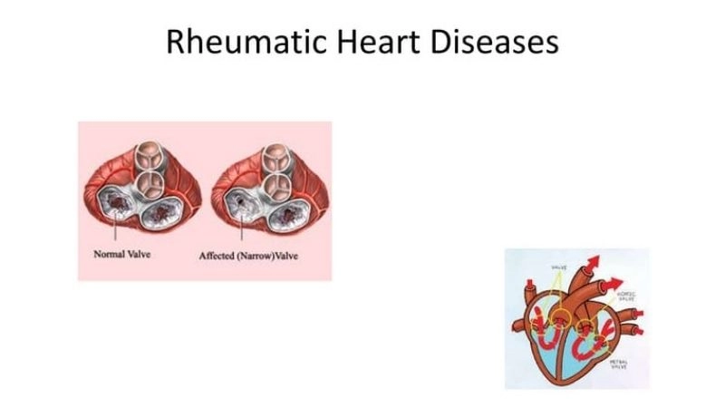 Rheumatic heart disease diagnosis through echo and tests