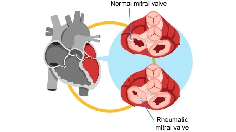 Acute rheumatic fever follows untreated strep infection