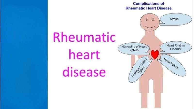 Rheumatic heart disease prevention with antibiotics