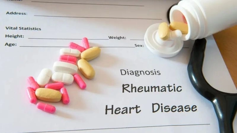 Mitral stenosis often linked to rheumatic damage