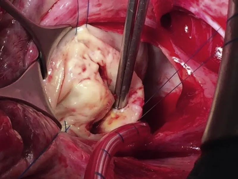 Key rheumatic heart disease prevention strategies