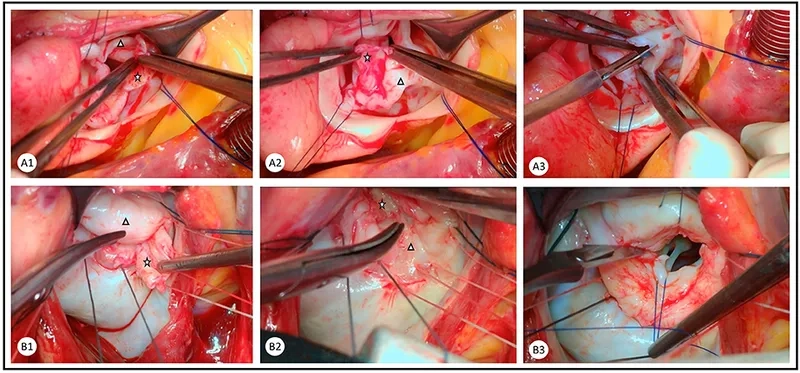 Exploring effective rheumatic heart disease treatment