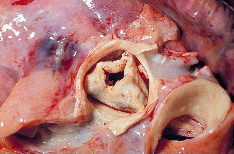 The link between strep throat and heart problems