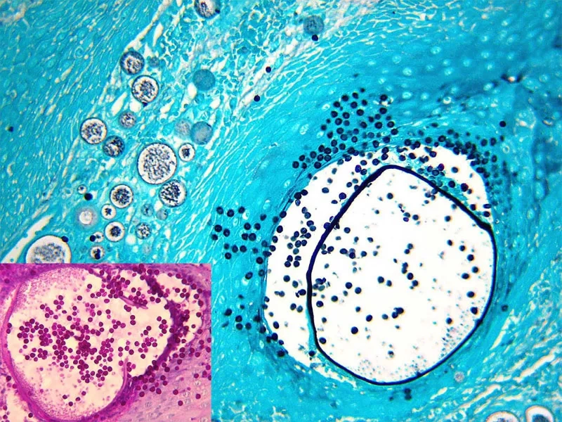A visual guide to key rhinosporidiosis symptoms