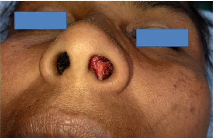 Distinguishing the condition from benign nasal polyps