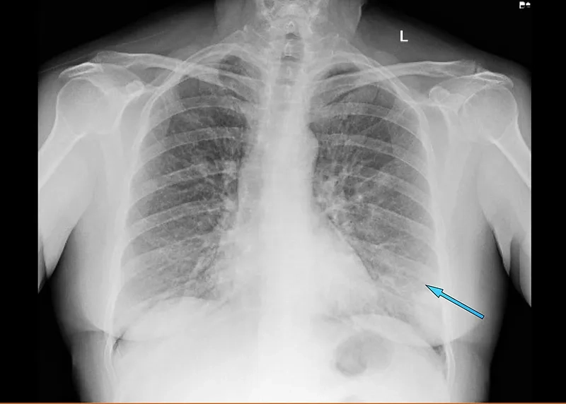 Person experiencing common cold symptoms