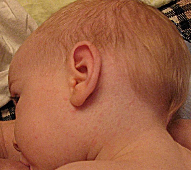 Understanding if roseola is contagious