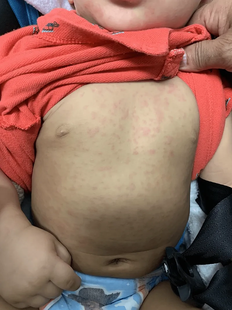 Human herpesvirus 6 (HHV-6) illustrated