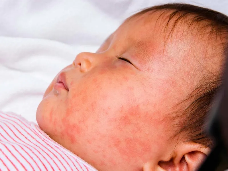 Supportive care and roseola treatment