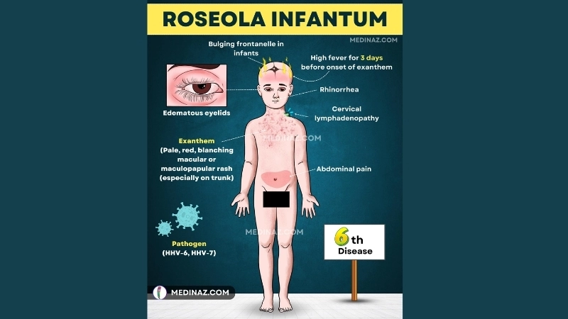 Roseola Infantum with Roseola symptoms guide