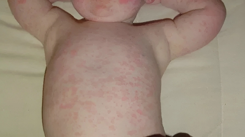 Roseola Infantum common Roseola fever cases