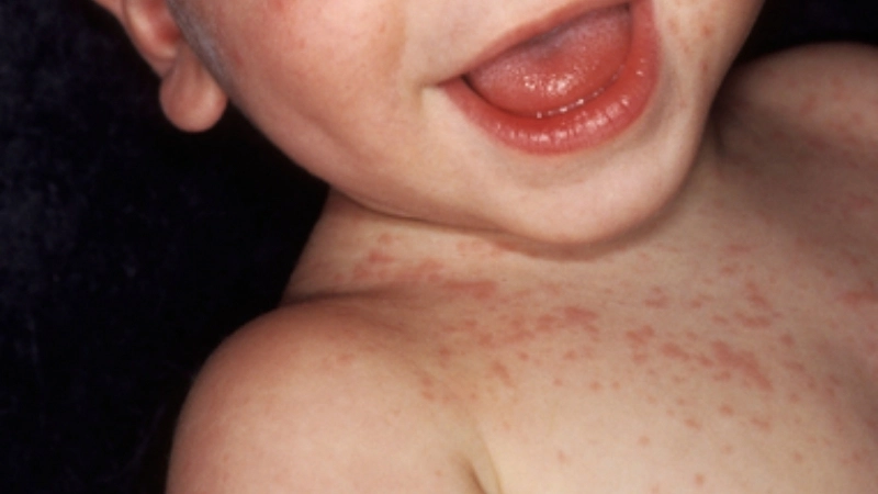 Roseola Infantum showing Roseola rash clearly