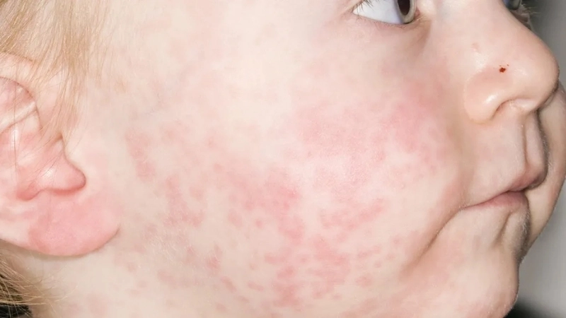 Roseola Infantum may lead to Roseola complications