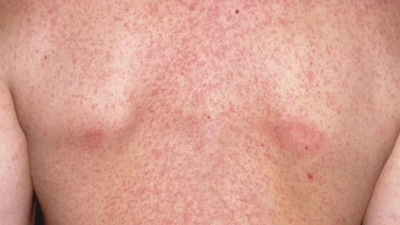 German measles rash from Rubella