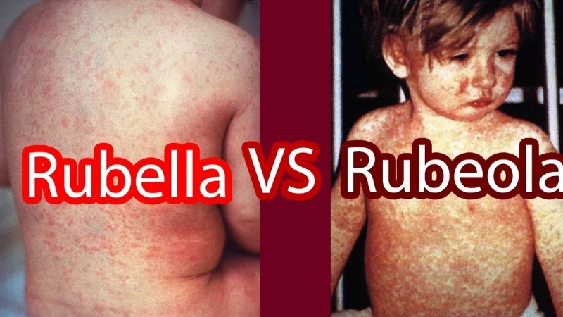 Rubella pregnancy risks are high