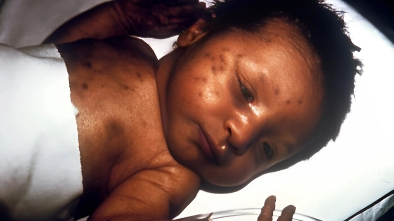 Rubella treatment helps German measles