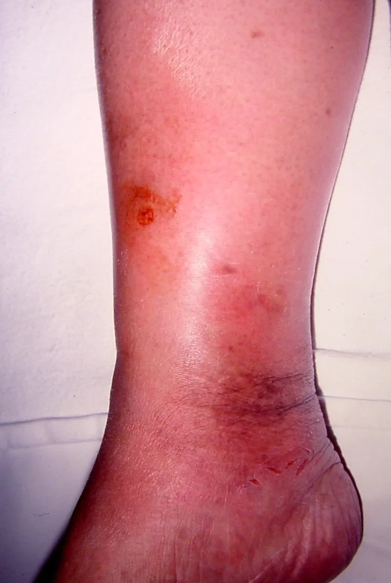 Undercooked eggs can be a source of Salmonella from eggs